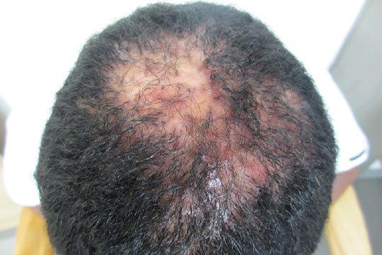 Best Hair Transplant in Mumbai