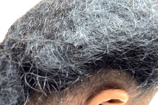Hair transplant near me